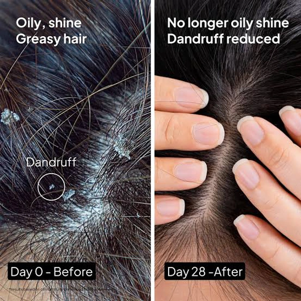Scalp peel