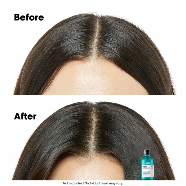 Loreal Professionnel Scalp Advanced Anti-Discomfort Shampoo 300ml |For Sensitive Scalp