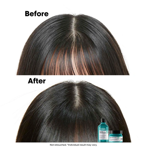 Loreal Professionnel Scalp Advanced Anti-Gras Oiliness Shampoo 300ml -With 4% AHA Purify Oily Scalp