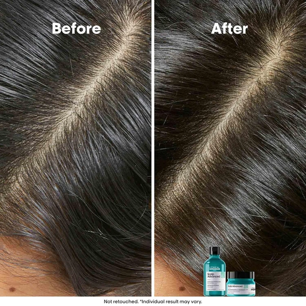 Loreal Professionnel Scalp Advanced Anti-Gras Oiliness Shampoo 300ml -With 4% AHA Purify Oily Scalp