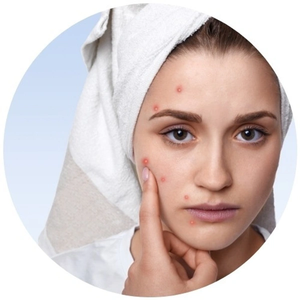 Bacterial & Acne-Prone Skin