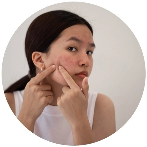 Blemish-Prone Skin