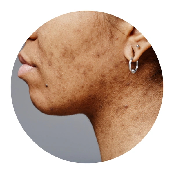 Blemish-Prone Skin