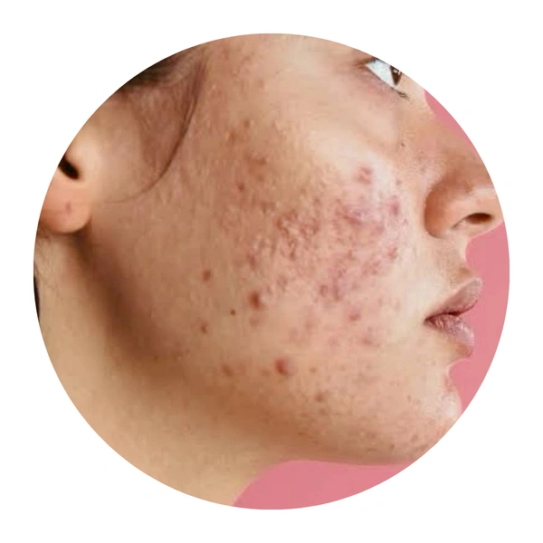 Bacterial & Acne-Prone Skin
