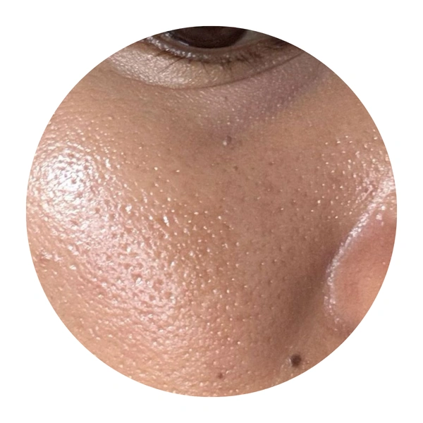 oily Skin